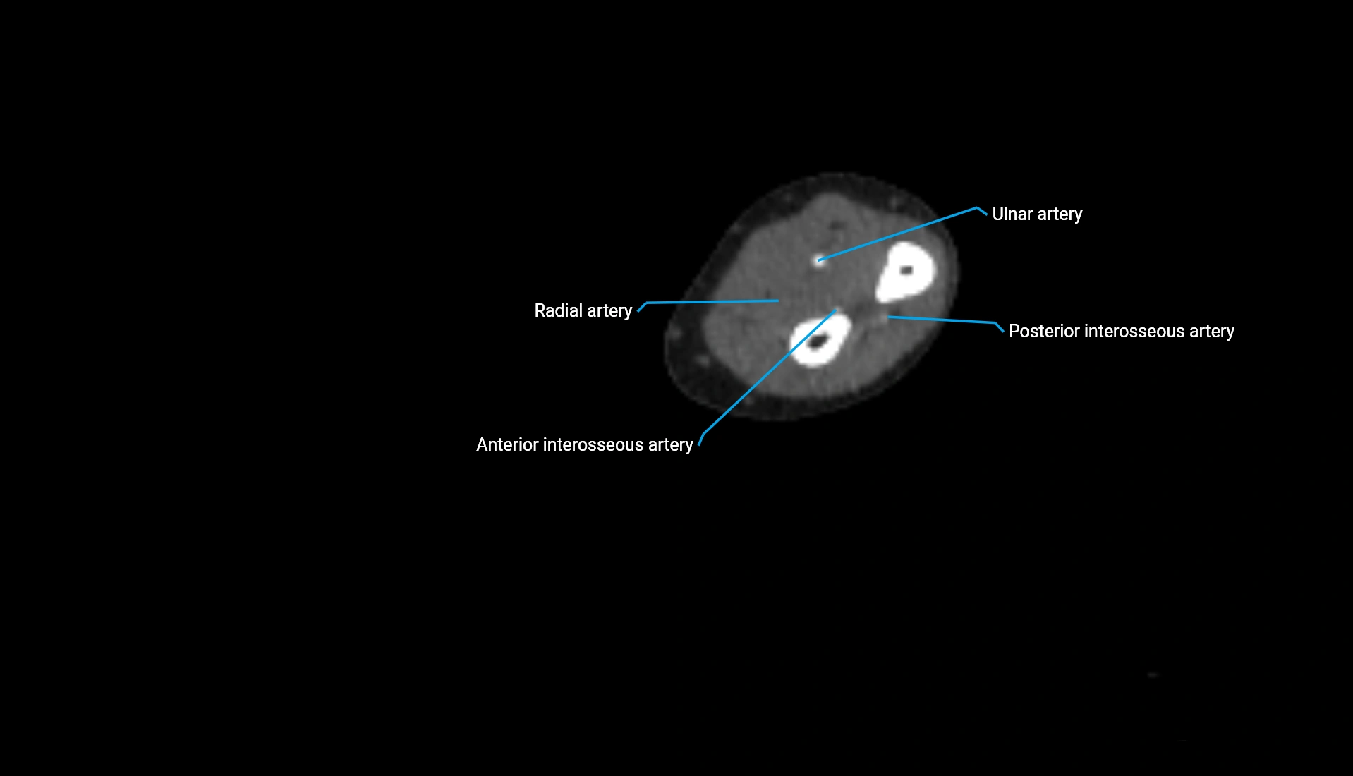 CTA upper limb axial cross sectional anatomy labelled image 151 (2).webp
